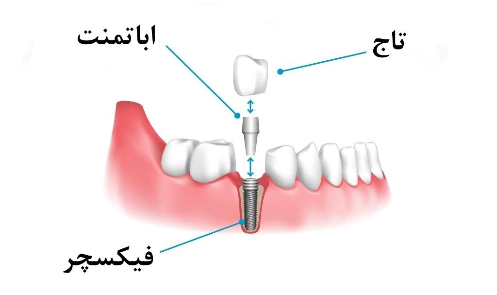 اجزای تشکیل‌دهنده ایمپلنت دندان