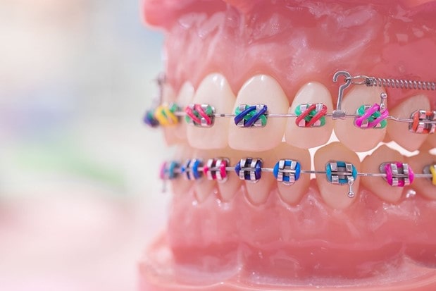 ارتودنسی دندان: انواع ثابت و متحرک، سن مناسب، مزایا، عوارض