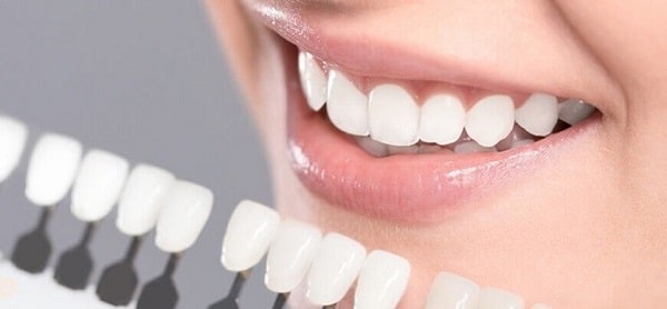 لمینت دندان چیست؟