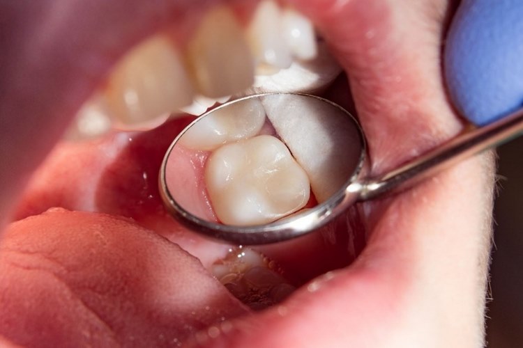 انواع پرکننده‌های دندان