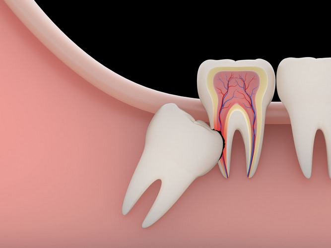 درمان دندان عقل نهفته چگونه انجام می شود