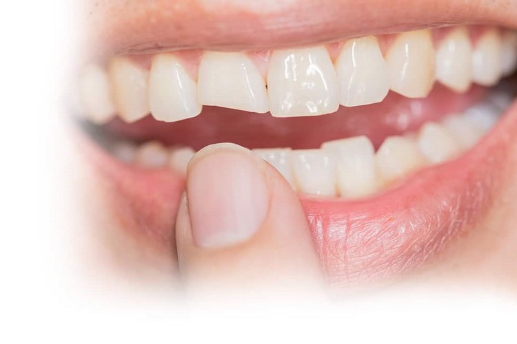 لمینت‏های بدون تراش چه مزایایی دارند