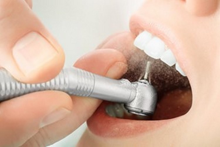 پرکردن دندان و انواع پر کننده‌‏های دندانی + هزینه