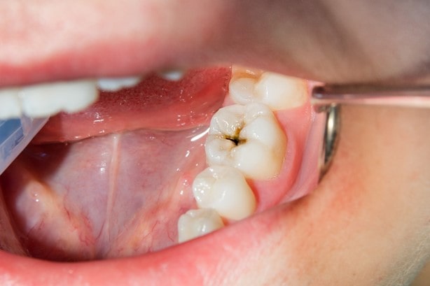 علل پوسیدگی دندان در خردسالان