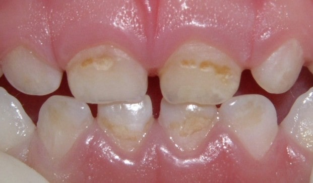 پوسیدگی دندان در کودکی