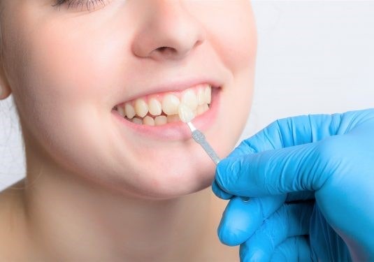 قیمت انواع لمینت سرامیکی، لومینیرز، متحرک در سال 1401 2 هزینه انجام لمینت