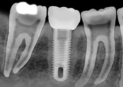آمادگی برای کاشت دندان