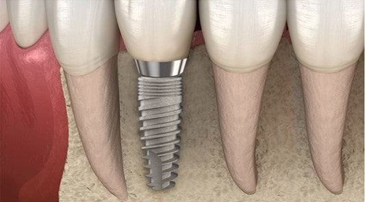 استئواینتگراسیون