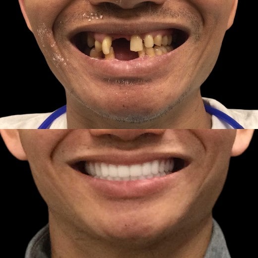 افراد مناسب جهت انجام کاشت دندان