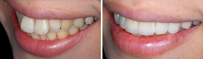 افراد مناسب کامپوزیت دندانی برای دندان های خرگوشی