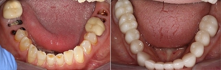 تاثیرات کاشت دندان