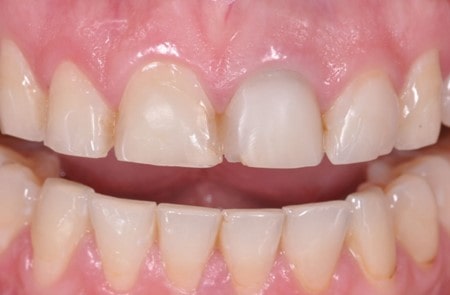 تروما و پوسیدگی دندان