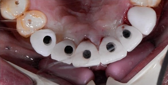 تنظیمات لثه برای ایمپلنت