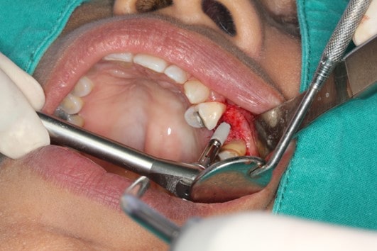 جراحی ایمپلنت دندان