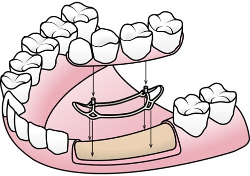 ساب پریوستال