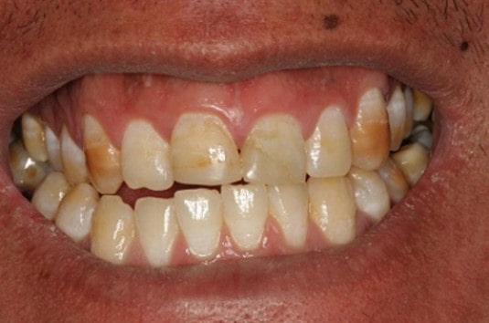 مشکلات کامپوزیت برای دندان