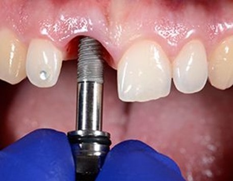 قرار دادن ایمپلنت