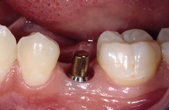 قرارگیری اباتمنت