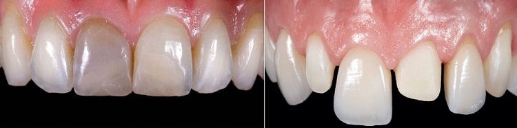 لمینت های سرامیکی برای چه افرادی مناسب است؟