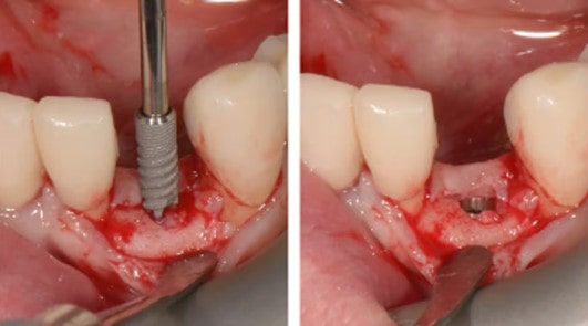 زمان انجام ایمپلنت دندان