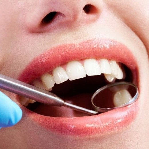مراقبت از لمینت های سرامیکی