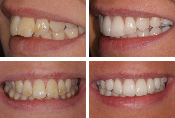 مزایای کامپوزیت ونیر برای دندان های خرگوشی