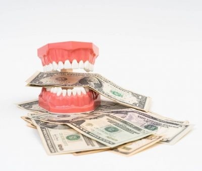 هزینه روکش های کامپوزیتی برای دندان های خرگوشی