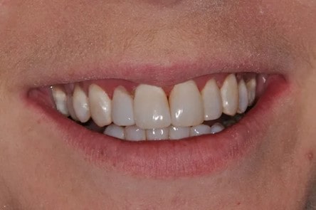 پوسیدگی دندان