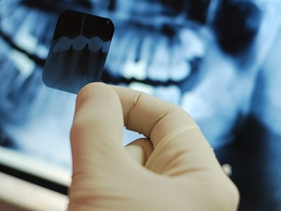 تشخیص پریودنتیت