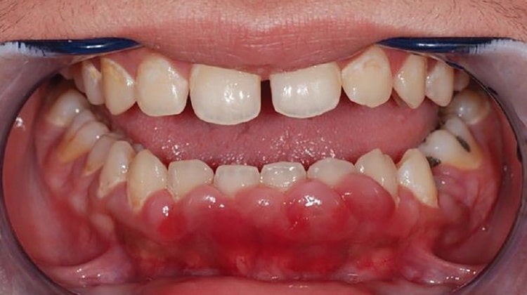 افزایش خطر ابتلا به پریودنتیت