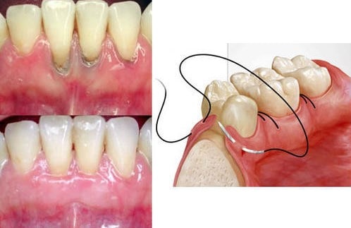 درمان پریودنتیت به روش جراحی