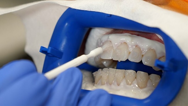 روش درمانی بلیچینگ دندان