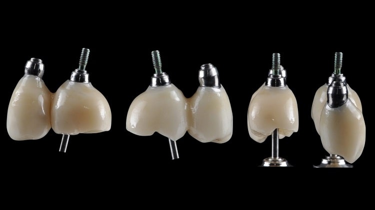 روکش‌هایی که به ایمپلنت پیچ می‌شوند