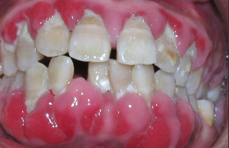 علائم پریودنتیت