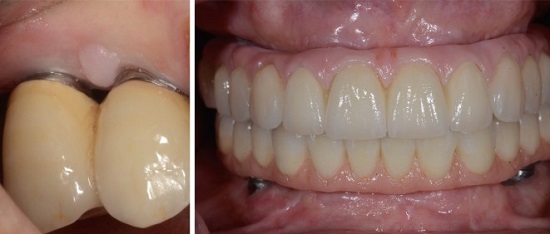 مرحله‌بندی جدا شدن ایمپلنت از استخوان