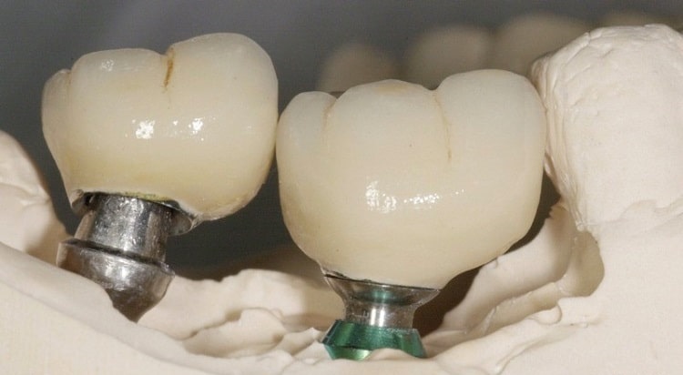 پرسلن ادغام شده فلز PFM