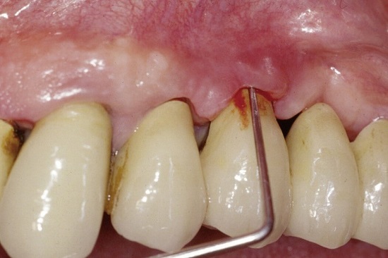 پری ایمپلنتیتیس