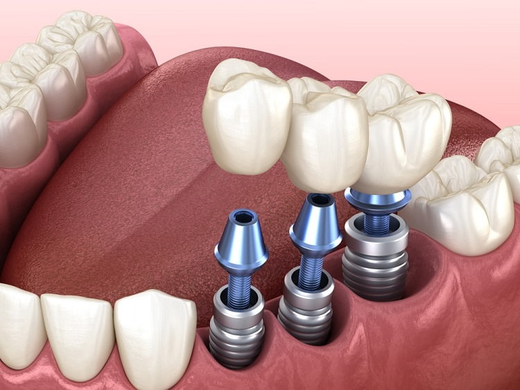 https://clinicgholhak.com/ ایمپلنت دندان