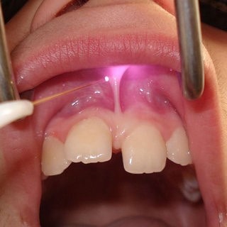 جراحی از بین بردن فاصله بین دندان‌ها