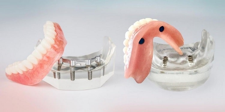 دندان مصنوعی بر پایه ایمپلنت