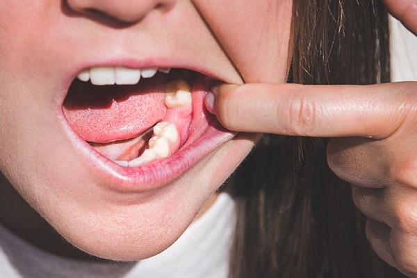 کیست دندان چیست؟ علائم و روش‌های درمان آن کدام‌اند؟ - درمانگاه دندانپزشکی حکیم