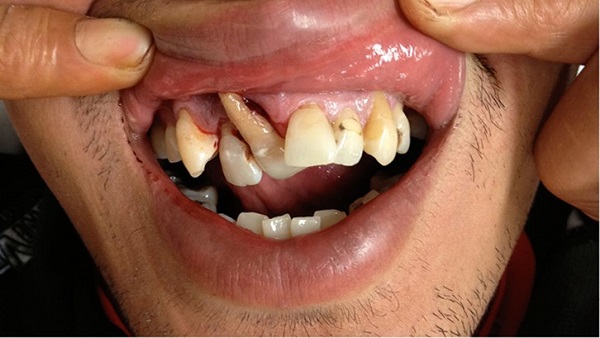 آسیب‌دیدگی دندان