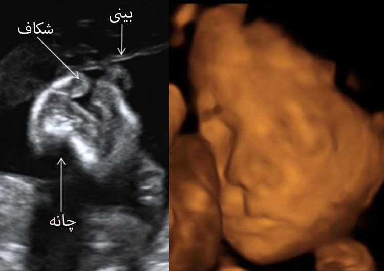 تشخیص شکاف کام و لب