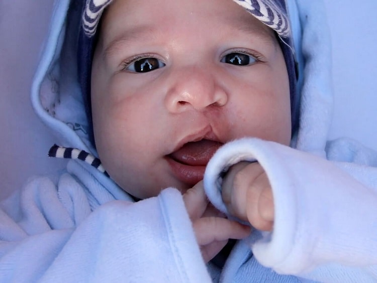 علائم شکاف لب و کام
