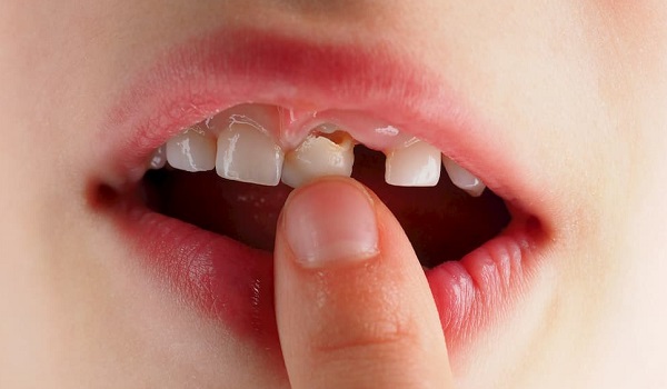 علائم همراه با لقی دندان