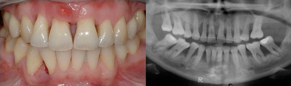 پوکی‌استخوان