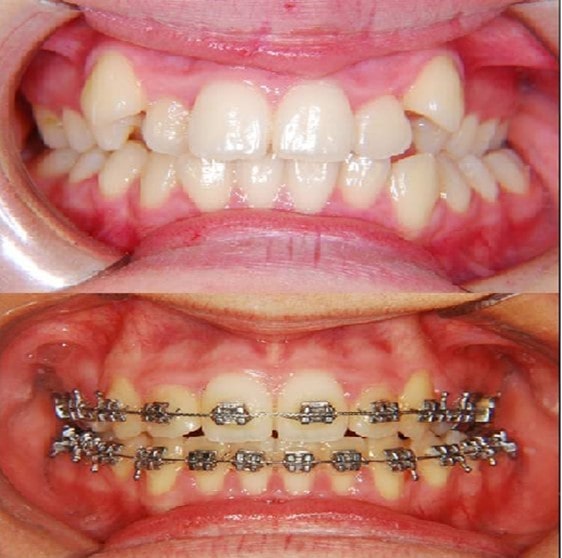 ارتودنسی برای دندان های نیش بیرون زده