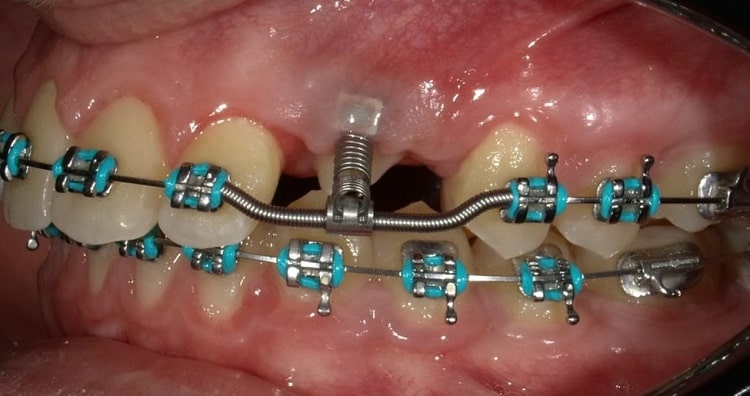 ارتودنسی برای دندان های نیش نهفته