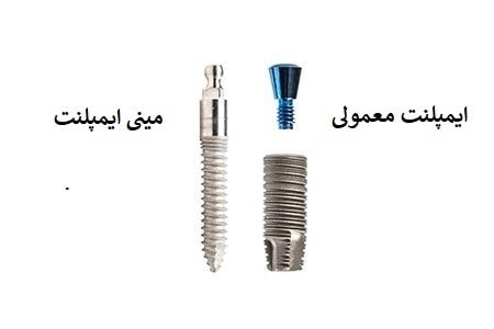 تفاوت بین ایمپلنت معمولی و مینی ایمپلنت