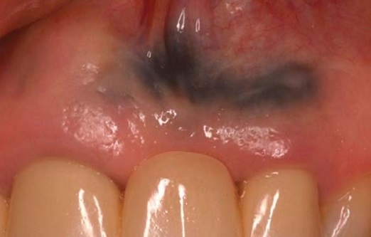 4.خالکوبی آمالگام (آمالگام تتو)